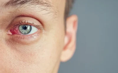 Red Eyes: Common Causes & When to See an Eye Doctor