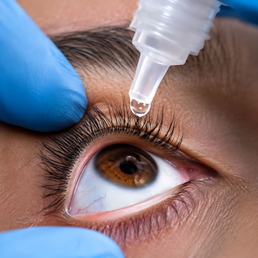 Patient receiving eyelid hygiene with tear drops